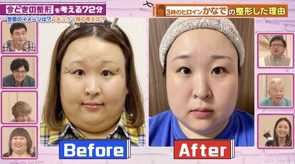 【写真・画像】3時のヒロイン・かなで、整形ビフォーアフターを公開「自然」「めちゃくちゃうまい」整形総額6000万円タレントも絶賛 1枚目