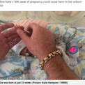 妊娠23週で誕生　手の大きさが父の親指の爪と同じだった女児、来月で1歳に（英）