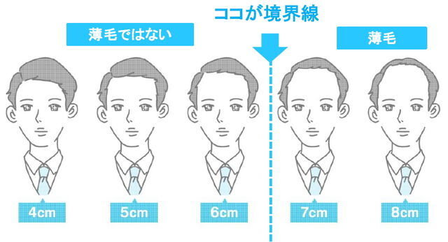 おでこの広さが何cm以上だと 薄毛 なのか ニコニコニュース