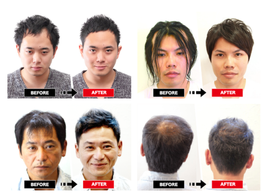 髪のコンプレックス克服に 美容室 の新たな選択肢を 正解率5 6 半数が 植毛 かつら と間違えた驚きの薄毛対策 ニコニコニュース