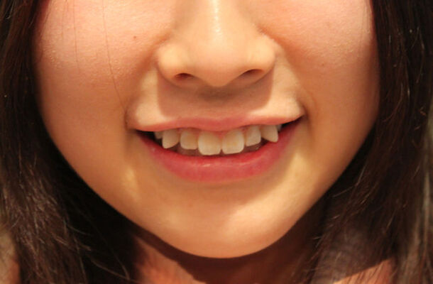 八重歯女子が最近増えた その真相を直撃 ニコニコニュース 八重歯女子が最近増えた その真相を直撃 ニコニコニュース