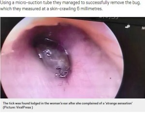 耳の中から6ミリのマダニを摘出 50歳女性が耳鳴りで気づく タイ 動画あり ニコニコニュース 耳の中から6ミリのマダニを摘出 50歳女性が耳鳴りで気づく タイ 動画あり ニコニコニュース