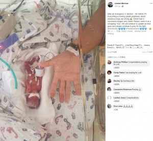 369グラムの赤ちゃん 元気に産声をあげて誕生 米 動画あり ニコニコニュース 369グラムの赤ちゃん 元気に産声をあげて誕生 米 動画あり ニコニコニュース