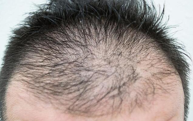 坊主頭はよけいに薄毛が目立つ 美容師が教える薄毛隠し最前線 ニコニコニュース 坊主頭はよけいに薄毛が目立つ 美容師が教える薄毛隠し最前線 ニコニコニュース