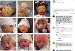 50万人に1人の難病 全身の皮膚がひび割れる娘の姿をsnsに公開する母の願い 米 動画あり ニコニコニュース