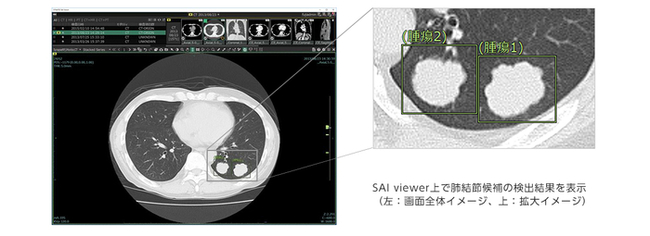 Ai技術 1を活用して肺がん診断における胸部ct画像の肺結節 2検出を支援 Aiプラットフォーム Synapse ニコニコニュース