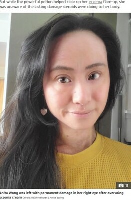 アトピー性皮膚炎でステロイドを25年 副作用で地獄を見た女性 ニュージーランド ニコニコニュース