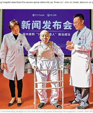 背骨が弓なりに曲がり28年 4度の手術で生まれ変わった46歳男性 母の顔を正面から見れるように 中国 ニコニコニュース 背骨が弓なりに曲がり28年 4度の手術で生まれ変わった46歳男性 母の顔を正面から見れるように 中国 ニコニコニュース