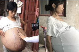 原因不明 中国に住む女性がまるで風船のようにお腹が膨らむ謎の症状に苦しめられる ニコニコニュース 原因不明 中国に住む女性がまるで風船のようにお腹が膨らむ謎の症状に苦しめられる ニコニコニュース