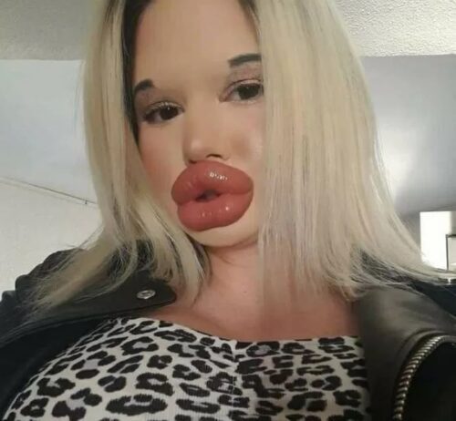 閲覧注意 セクシーな唇が欲しい と25回も注入治療を繰り返した女性 とんでもない唇になってしまう ニコニコニュース